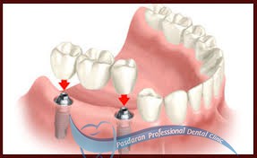 پروتزهای ثابت دندانی
