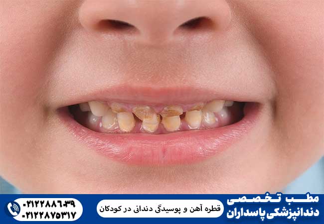 قطره آهن و پوسیدگی دندانی در کودکان