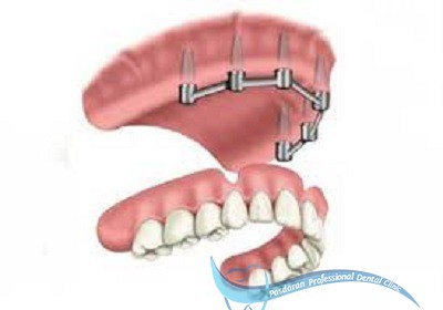 پروتزهای ثابت دندانی
