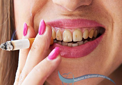 آیا دندانها با دود سیگار از بین می روند ؟