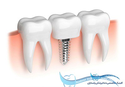 مشکلات پروتزی در مورد یک دندان Hopeless