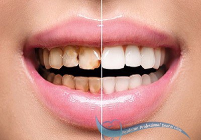 تغییر رنگ دندانها در اثرعوامل ژنتیکی و خارجی