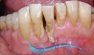 مشکلات پروتزی در مورد یک دندان با پروگنوز ضعیف