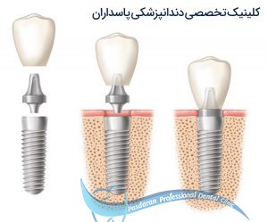 مراحل_کاشت_دندان_یا_ایمپلنت_دندان