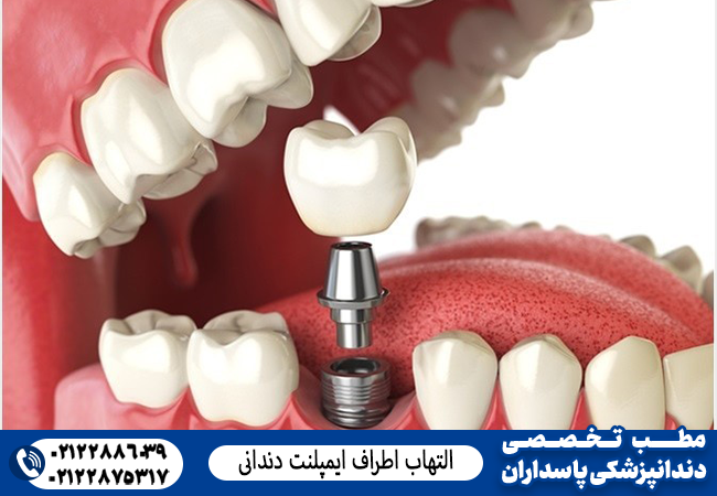 التهاب اطراف ایمپلنت دندانی
