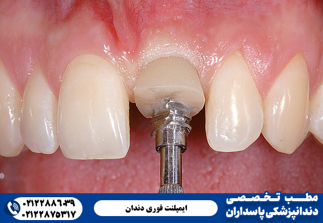 ایمپلنت فوری دندان چیست