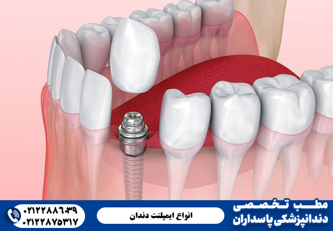 ایملنت دندان براساس نوع کاشت و جراحی انواع مختلفی دارد.