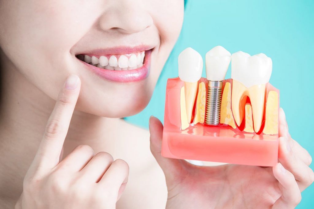 ایمپلنت دندان چیست و چه کارایی دارد؟