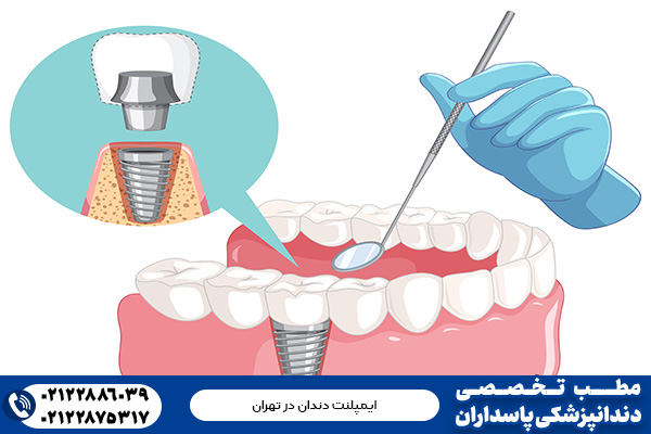 ایمپلنت دندان در پاسداران تهران