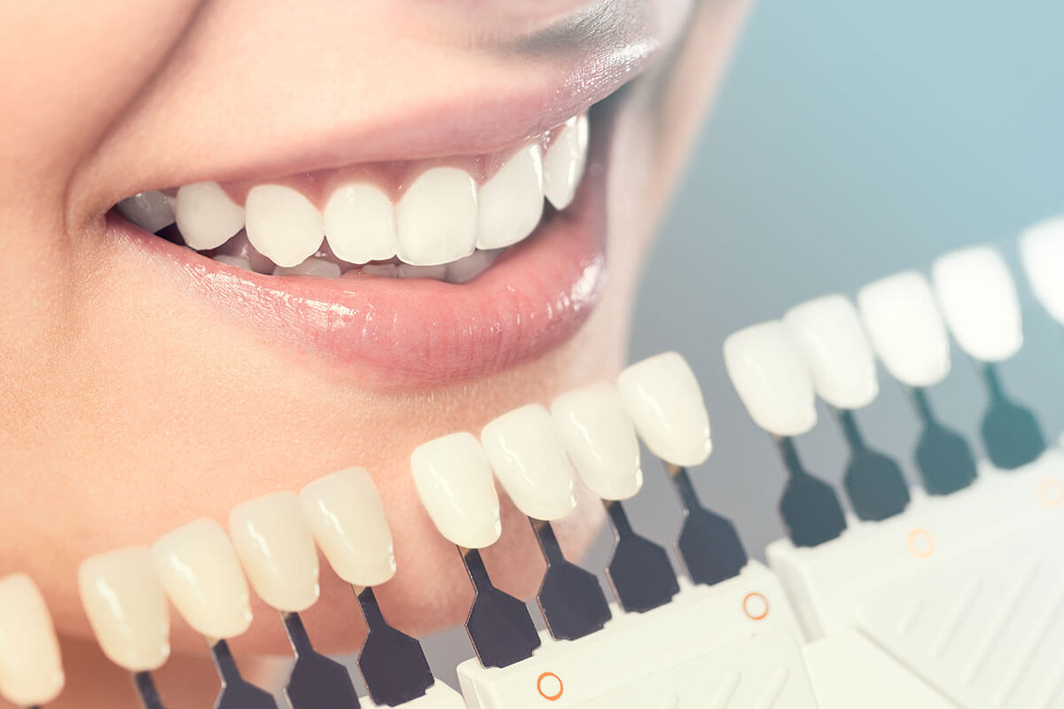 فرق بین جرم گیری و بلیچینگ دندان چیست؟