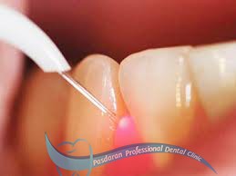 مزایای پر کردن دندان با لیزر دندانپزشکی