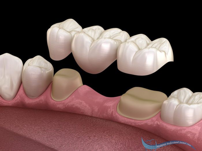 عوامل موثر بر قیمت پروتز دندانی کدامند؟