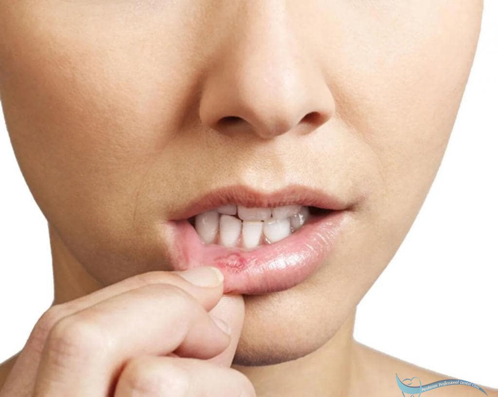 بیماری سرطان دهان چیست و چه علائمی دارد؟