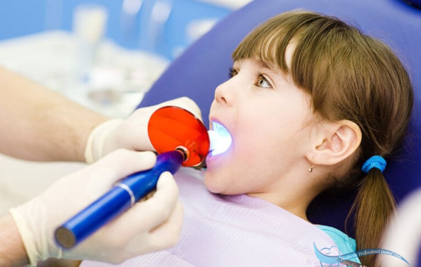 اهمیت سیلانت ها در دندانپزشکی کودکان