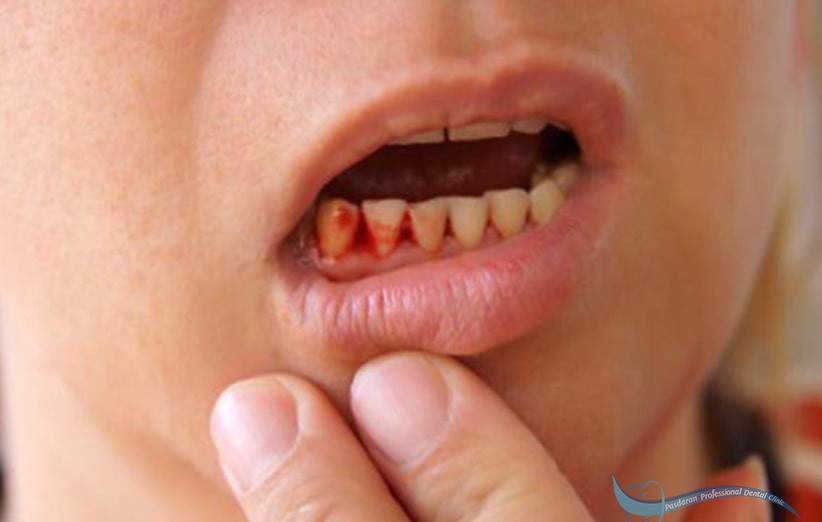 علل خونریزی دندان در کودکان چیست؟